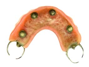 Prótesis dental parcial de arriba sobre implantes dentales dentadura parcial de arriba sobre implantes Prótesis dental parcial de arriba sobre implantes dentales dentadura parcial de arriba sobre implantes