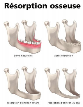 Dental relining soft or hard bone resorption