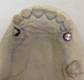 Modelo parcial dental de arriba sobre implantes dentales