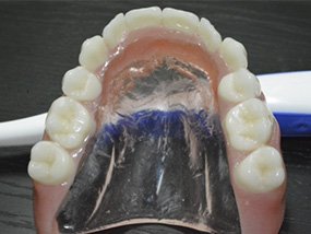 Prótesis dental completa arriba paladar transparente dentadura
