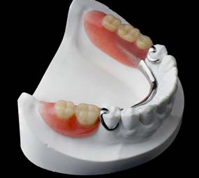 Prótesis dental parcial de abajo metálico vitallium dentadura parcial