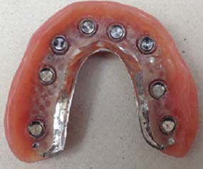 Dental prosthesis complete removable of top on 8 implants denture of top removable on 8 implants